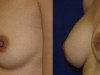 3b-breast-enlargement